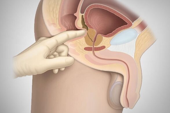 Masaxe prostática para prostatite bacteriana